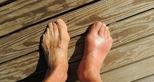 Tỷ lệ bệnh nhân mắc bệnh gout gia tăng do đâu