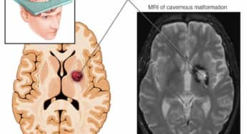 U máu thể hang, Cavernoma, trong não