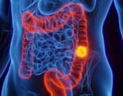 Ung thư đại trực tràng hiện là nguyên nhân hàng đầu gây tử vong do ung thư ở những người dưới 50 tuổi