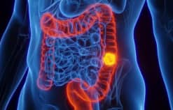 Ung thư đại trực tràng hiện là nguyên nhân hàng đầu gây tử vong do ung thư ở những người dưới 50 tuổi
