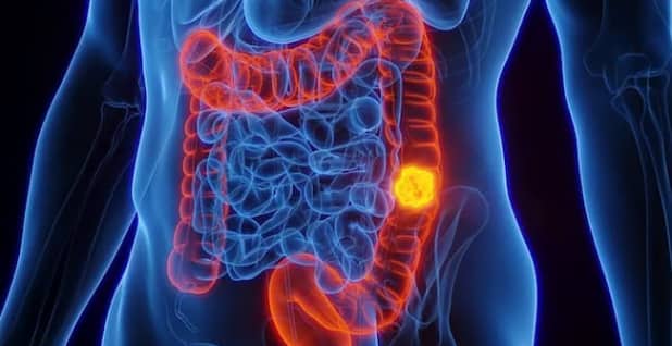 Ung thư đại trực tràng hiện là nguyên nhân hàng đầu gây tử vong do ung thư ở những người dưới 50 tuổi