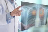 Ung thư phổi không tế bào nhỏ: nguyên nhân và yếu tố rủi ro