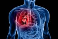 Ung thư phổi không tế bào nhỏ là gì? Chia sẻ của bệnh nhân