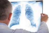 Ung thư phổi tế bào nhỏ, ung thư phổi không tế bào nhỏ và sự khác biệt