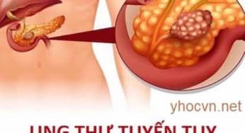 Ung thư tuyến tụy: Chẩn đoán, hóa trị và các tác dụng phụ gặp phải