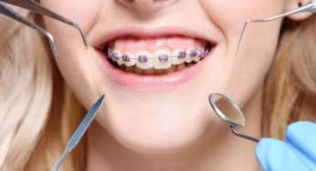 Vấn đề thường gặp của chỉnh nha bạn nên biết