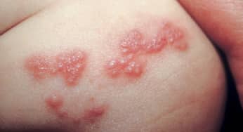 Vết loét lạnh: biến chứng nguy hiểm, nguyên nhân, hướng điều trị