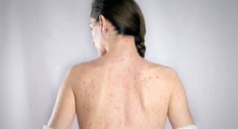 Vì sao người trưởng thành gặp biến chứng nặng khi mắc sởi