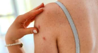 Viêm da mủ hoại thư triệu chứng của bệnh đường ruột