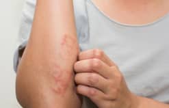 Viêm da tiếp xúc dị ứng: nguyên nhân, triệu chứng, cách phòng ngừa chuẩn