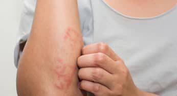 Viêm da tiếp xúc dị ứng: nguyên nhân, triệu chứng, cách phòng ngừa chuẩn