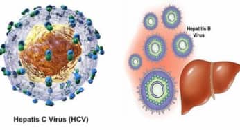 Viêm gan virus C