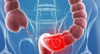 Viêm miệng mủ sùi cảnh báo viêm loét đại tràng