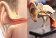 Viêm tai giữa cấp tính: Nguyên nhân, triệu chứng, điều trị