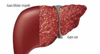 Xơ gan phát triển như thế nào