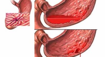 Xuất huyết tiêu hóa trên không do tăng áp lực tĩnh mạch cửa